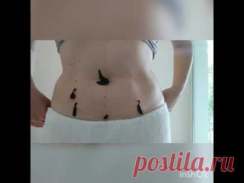 Пиявки на живот Часть1. Сигмавидную кишку, переход тонкого кишечника в толстый, пупок, область матки