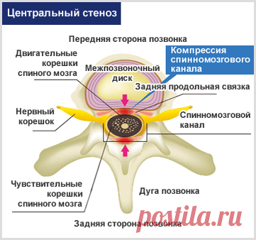 Симптомы стеноза позвоночного канала | International Lumbago Clinic | Дзен