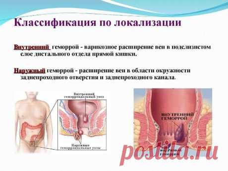 Тромбоз геморроидального узла: симптомы, признаки, и способы лечения