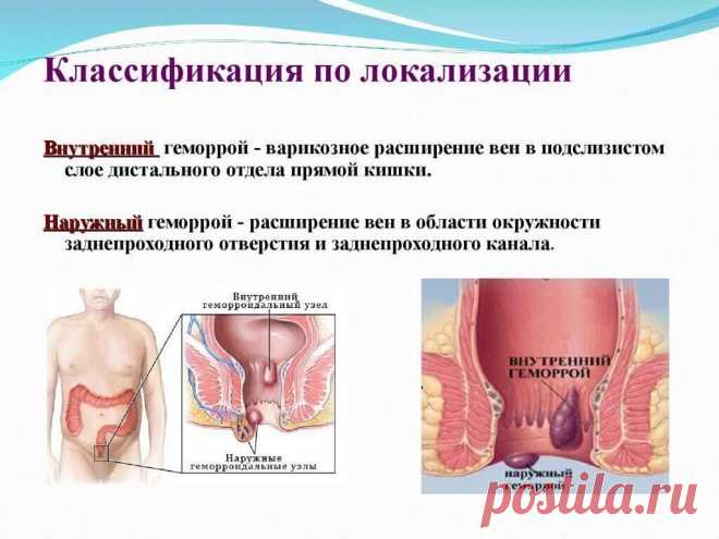 Тромбоз геморроидального узла: симптомы, признаки, и способы лечения