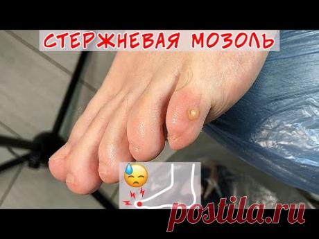 Удаление стрежневой мозоли на мизинце