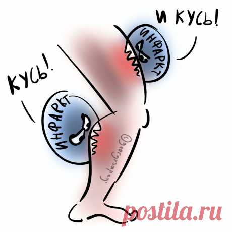 Диабетический инфаркт кусает ногу за окорочок спереди и за голяшку сзади | Для пациентов | Яндекс Дзен