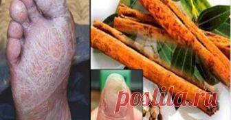 Используйте корицу таким образом, и никакой грибок ваших ног или рук не выдержит этот гербицид 


Вы полюбите это средство!







 


Грибок на ногтях — это инфекция, которая проникает через щели ваших ногтей на ногах или даже через раны на коже.
Если ногти обесцвечены, имеют странную форму ил…