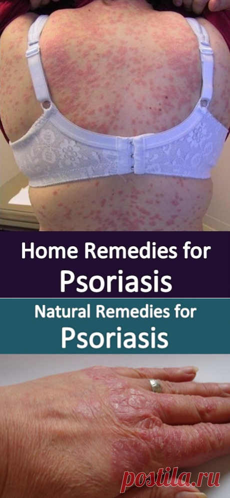 Home Remedies for Psoriasis | Virtual Clinic