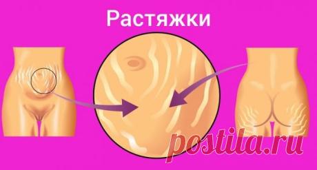 Куда делись растяжки? Копеечное средство из аптеки сделало кожу божественной — Полезные советы и рецепты