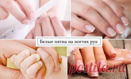 Белые пятна на ногтях рук как следствие нарушений в организме Многие люди встречались с таким явлением, как белые пятна на ногтях рук. Если пятнышек мало и по мере отрастания ногтя они исчезают, то волноваться нет причин. При постоянном появлении белых пятен или полосок не стоит их скрывать за маникюром, думая, что это всего лишь небольшая проблема. В этом случае может идти речь о такой патологии, как лейконихия.