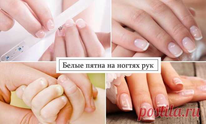 Белые пятна на ногтях рук как следствие нарушений в организме Многие люди встречались с таким явлением, как белые пятна на ногтях рук. Если пятнышек мало и по мере отрастания ногтя они исчезают, то волноваться нет причин. При постоянном появлении белых пятен или полосок не стоит их скрывать за маникюром, думая, что это всего лишь небольшая проблема. В этом случае может идти речь о такой патологии, как лейконихия.