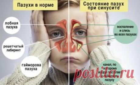 Узнайте, как капли от гайморита помогают быстро вылечить заболевание. Ознакомьтесь с разновидностями сосудосуживающих, масляных препаратов и антибиотиков.