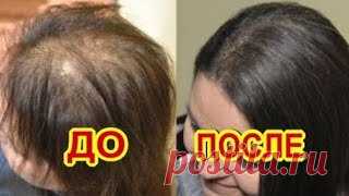Все в Шоке! Если Намазать Этим...Облысение Остановится! | С Лёгкой Руки | Дзен