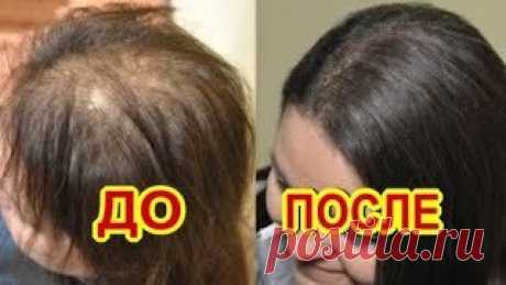 Все в Шоке! Если Намазать Этим...Облысение Остановится! | С Лёгкой Руки | Дзен