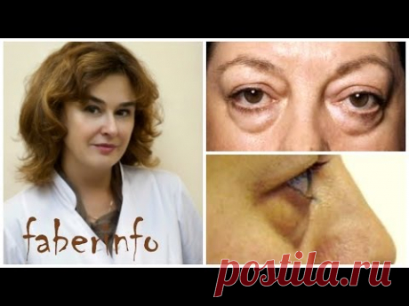 Убрать МЕШКИ под глазами БЕЗ РАЗРЕЗОВ.  Подтяжка век. Блефаропластика.