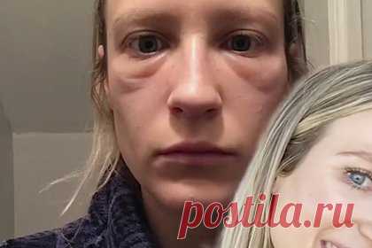 Блогерша показала неожиданные последствия популярной косметической процедуры. Блогер Брук Хатти из США сделала популярную косметическую процедуру и показала неожиданные последствия. По ее словам, в 2018 году она решила избавиться от первых признаков старения с помощью филлеров в области слезной борозды. На размещенных кадрах видно, что в области носа женщины образовались многочисленные отеки.