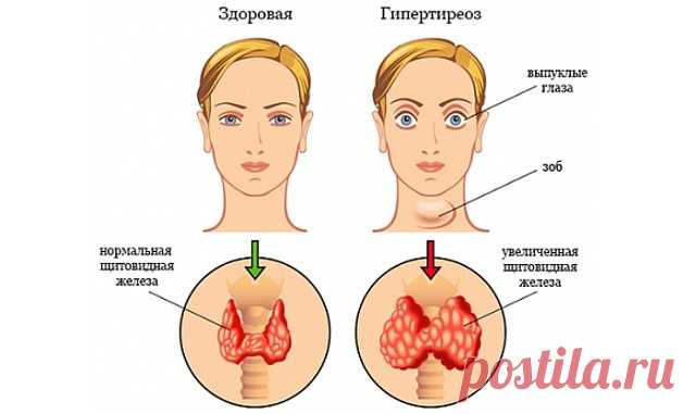 ЛЕЧЕНИЕ ЩИТОВИДКИ НАРОДНЫМИ СРЕДСТВАМИ. 🏻