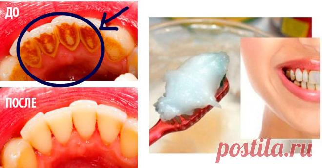 Как избавиться от зубного камня при помощи 1 простого средства.