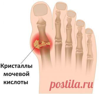 Как вывести лишнюю мочевую кислоту из организма?