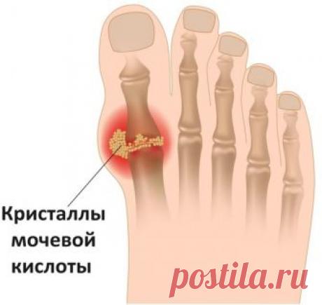 Как вывести лишнюю мочевую кислоту из организма?