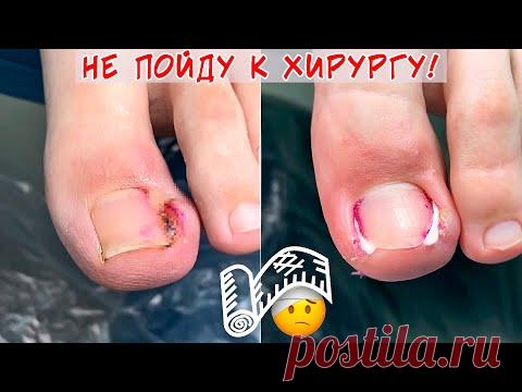 Вросший ноготь и гной под ногтем / Горький опыт обращения к хирургу
