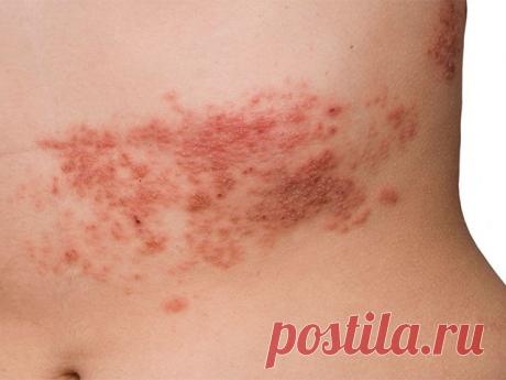 Bот чаще всего опоясывающий лишай появляется у тех, кому за пятьдесят. И в пожилом возрасте он протекает тяжело: резко выражена боль, не редко возникают осложнения. Чем же это обусловлено и как справиться с недугом?