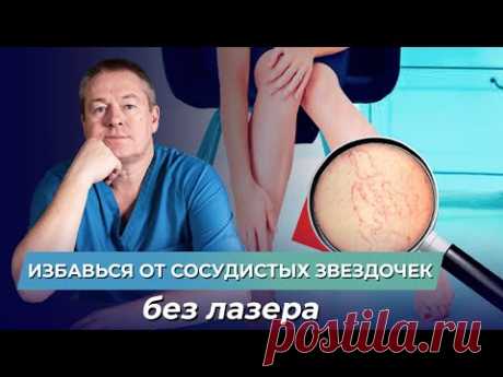 Как лечить капиллярные сетки на ногах? Как избавиться от сосудистых звездочек без лазеров и уколов?