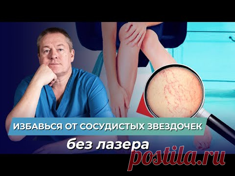 Как лечить капиллярные сетки на ногах? Как избавиться от сосудистых звездочек без лазеров и уколов?
