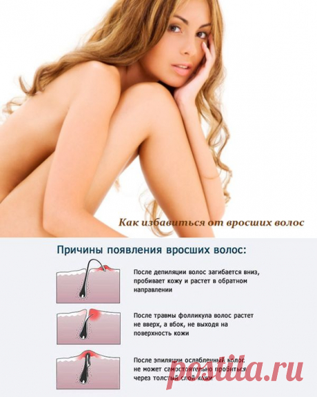 Как избавиться от вросших волос.