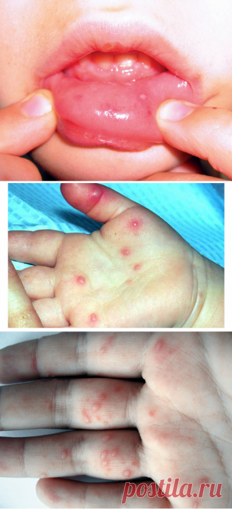Вирусная пузырчатка: как передается, какие симптомы, как лечить?