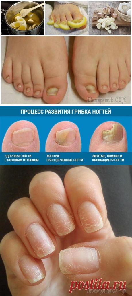 Грибок ногтей на ногах: причины, симптомы и способы лечения