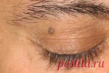 Рецепт избавления от папиллом | Здоровье | Само Совершенство