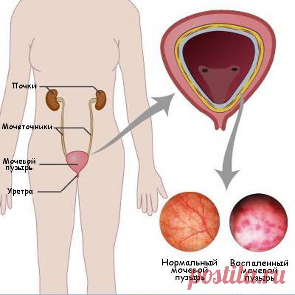 Цистит - симптомы, причины, профилактика и лечение, а также цистит при беременности