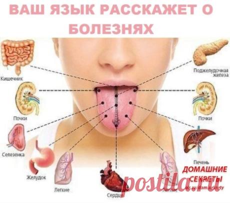 ВАШ ЯЗЫК РАССКАЖЕТ О БОЛЕЗНЯХ
Язык, помимо прочих важных функций, служит зеркалом организма – по нему можно определить и состояние иммунитета, и диабет, и проблемы с почками…
Считается, что чистый язык, без налета - признак здоровья пищеварительной системы. Но здесь все не так просто. Язык способен отражать состояние практически всех органов и систем. Например, кончик языка отвечает за тазовые органы, середина слева - за печень, а справа - за селезенку. Боковые края показы...
