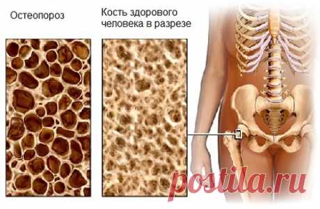Лечение остеопороза народными средствами — Здоровое Долголетие