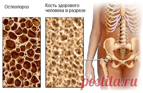 Лечение остеопороза народными средствами — Здоровое Долголетие
