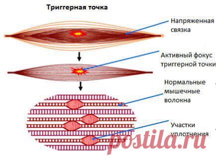 МОРФОЛОГИЯ РЕФЛЕКТОРНЫХ И АКУПУНКТУРНЫХ ТОЧЕК Аюрведический центр красоты и здоровья «Живая вода»

МОРФОЛОГИЯ РЕФЛЕКТОРНЫХ И АКУПУНКТУРНЫХ ТОЧЕК
Мельцак и Уолл (1988) показали, что как минимум 75% триггерных точек являются на самом деле, в соотве…