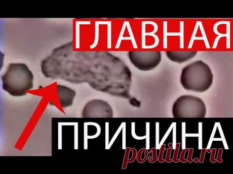 1 ПРИЧИНА МНОГИХ БОЛЕЗНЕЙ! Инфаркт, инсульт, рак, эпилепсия, диабет, рассеянный склероз и другие!