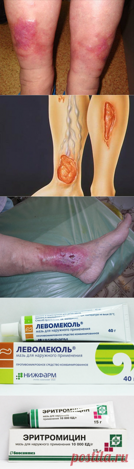 Мазь от трофических язв на ногах ⋆ Список лучших препаратов ⋆