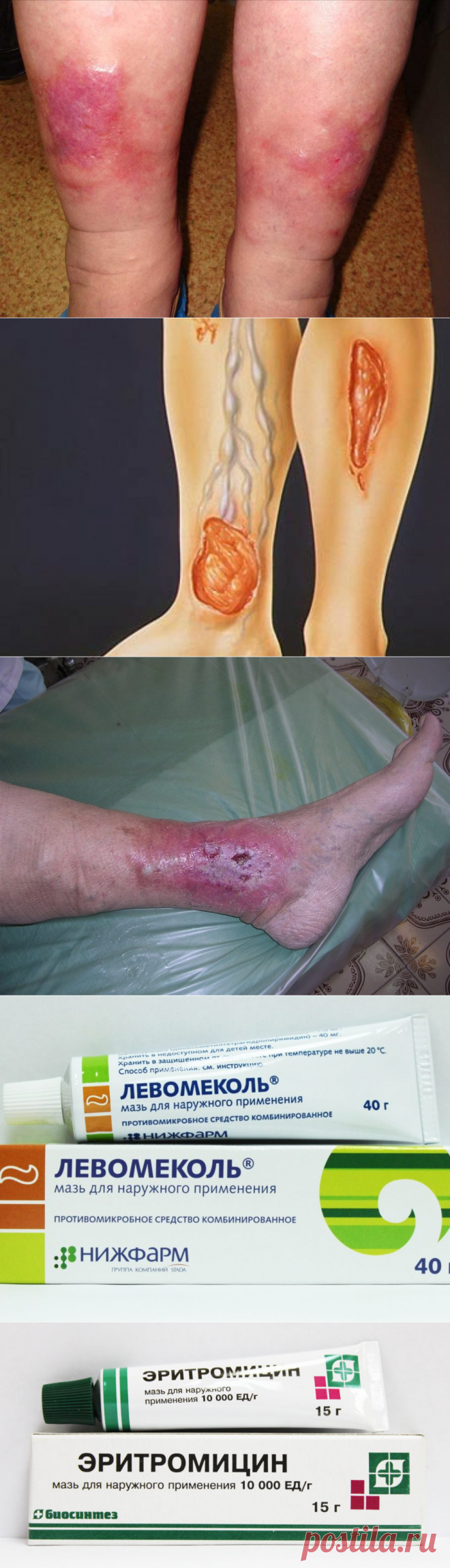 Мазь от трофических язв на ногах ⋆ Список лучших препаратов ⋆