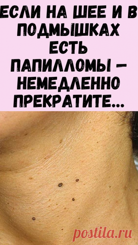 Сотни разновидностей вируса папилломы человека (ВПЧ) становятся причиной различных кожных заболеваний и поражений слизистых!
Заражение происходит в обычных бытовых ситуациях, и на первых этапах симптомов может и не быть! Местом размножения вируса становятся глубокие слои кожи, после чего он перемещается на зараженный эпителий, выходя на поверхность в виде папиллом или бородавок.
Именно в этот момент вирус становится заразным!