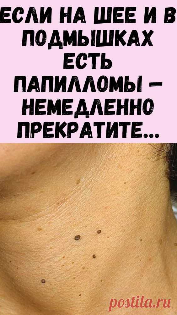 Сотни разновидностей вируса папилломы человека (ВПЧ) становятся причиной различных кожных заболеваний и поражений слизистых!
Заражение происходит в обычных бытовых ситуациях, и на первых этапах симптомов может и не быть! Местом размножения вируса становятся глубокие слои кожи, после чего он перемещается на зараженный эпителий, выходя на поверхность в виде папиллом или бородавок.
Именно в этот момент вирус становится заразным!