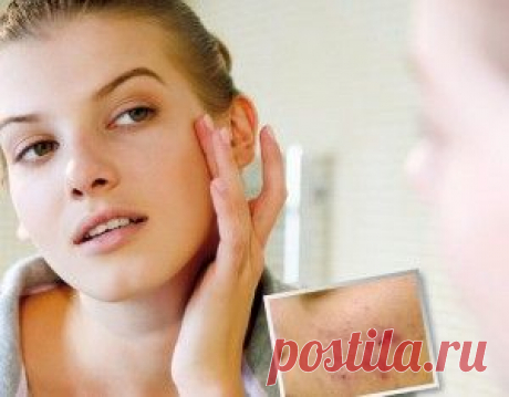 Жировик на спине: народные способы лечения