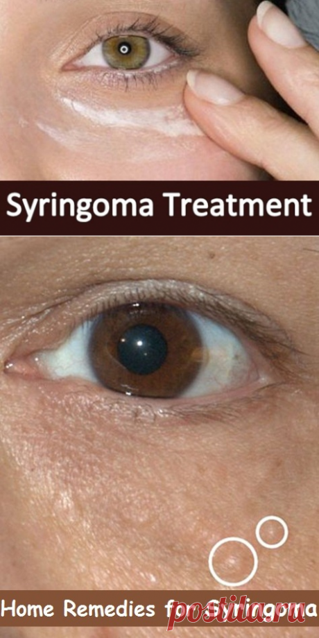 How to Get Rid of Syringoma | Virtual Clinic