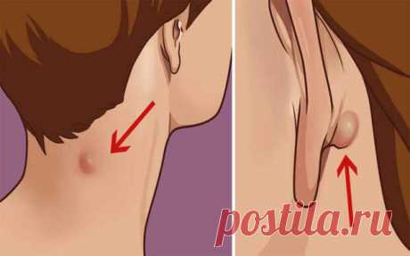 (30) Что нужно знать, если у вас есть такое уплотнение на шее или за ухом... - Познавательный сайт ,,1000 мелочей" - 2 августа - 43760376515 - Медиаплатформа МирТесен Небольшую опухоль на шее, лице и других частях тела по-научному называют эпидермоидной кистой. Это довольно распространенная проблема, которая на первых порах мало беспокоит пациентов и доставляет лишь эстетический дискомфорт. Что представляет собой эта киста? Опасна ли она? Как от нее избавиться? - 2 августа...