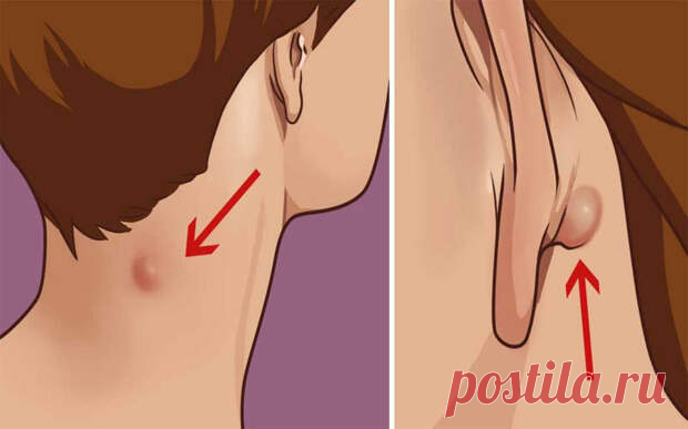 (30) Что нужно знать, если у вас есть такое уплотнение на шее или за ухом... - Познавательный сайт ,,1000 мелочей