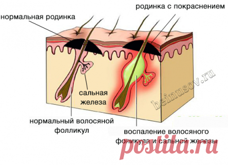 Что делать, если родинка воспалилась, покраснела или болит