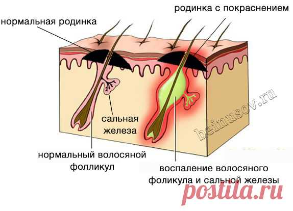 Что делать, если родинка воспалилась, покраснела или болит