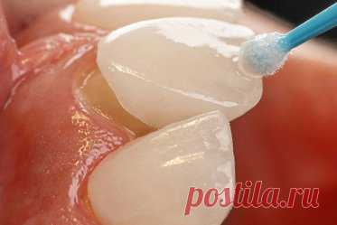 Виниры, люминиры, ультраниры: что выбрать и как за ними ухаживать?. Чем отличаются виниры, люминиры, ультраниры? Что лучше выбрать и как правильно за ними ухаживать?