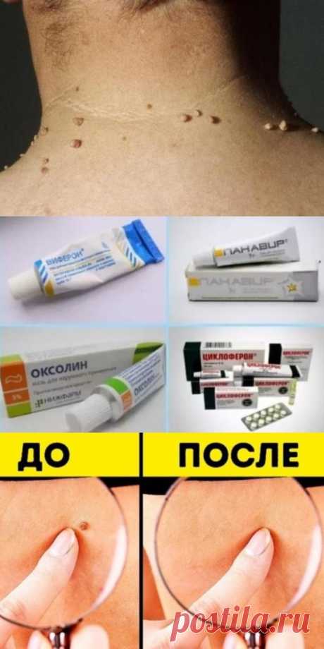 как вывести бородавки карандашом	Нитрат серебра, известный еще под названием «ляпис», изготовленный в форме белого конуса, давно применяется для выведения кожных наростов. Это наиболее известный карандаш от бородавок и папиллом.