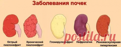 ВСЕ БОЛЕЗНИ: ПОЧЕК: 2 тыс изображений найдено в Яндекс Картинках