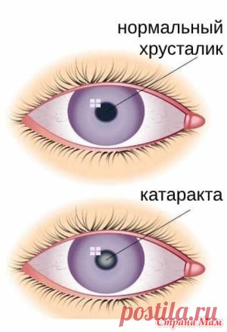Катаракта и вязание Кто, как не рукодельницы, поймет мои опасения! И с кем, как не с увлечёнными вязальщицами на любимом сайте, посоветоваться!  У меня диабет Лада и катаракта. Сахар скачет с большой амплитудой.