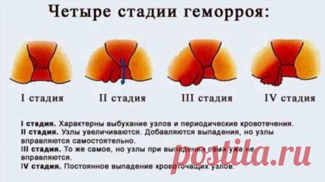 Лечение геморроя — рецепты мы не скроем. Очень средства ценные, в лечении отменные | Люблю Себя