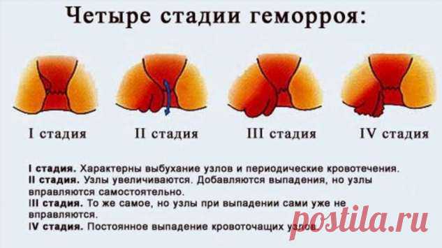 Лечение геморроя — рецепты мы не скроем. Очень средства ценные, в лечении отменные | Люблю Себя